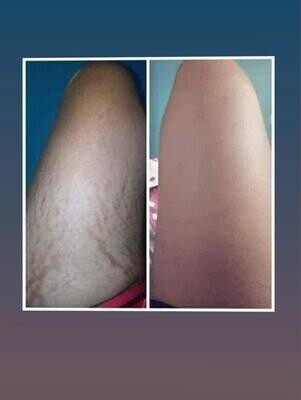 Stretch Mark Oil - 200ml