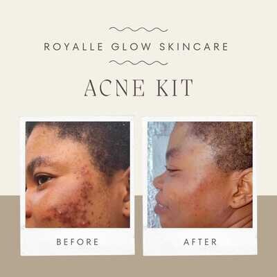 Side-by-side facial skin photo with an Acne Kit heading