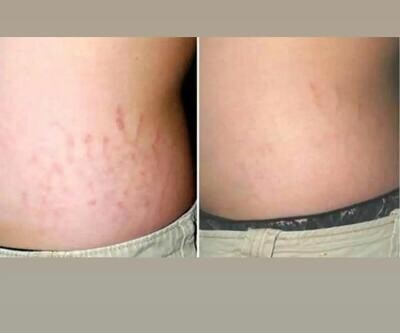 Stretch Mark Oil - 200ml
